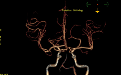Mr. Humulus Recurrent basilar artery occlusion